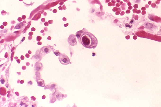 Virus porcine cytomegalovirus ở loài lợn được nghi là nguyên nhân gây ra vụ việc đáng tiếc trên. Ảnh Internet