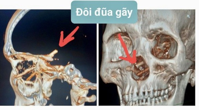 Phát hiện đôi đũa nằm trong hộp sọ của bệnh nhân.