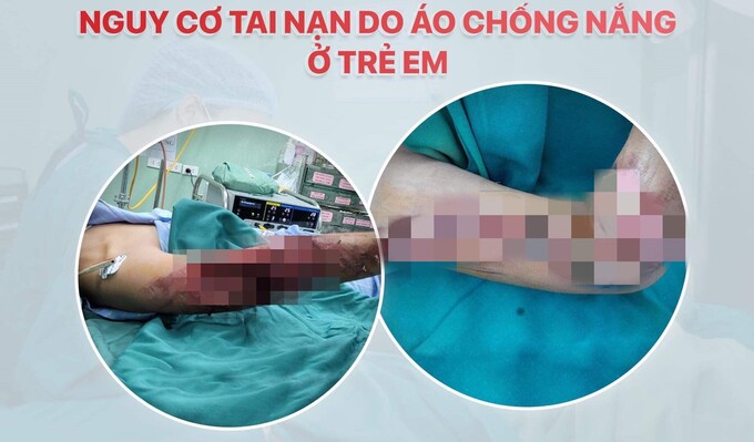 Bệnh nhi được chẩn đoán gãy hở TLC xương cánh tay phải, vết thương mất phần mềm lớn (Ảnh BVCC)